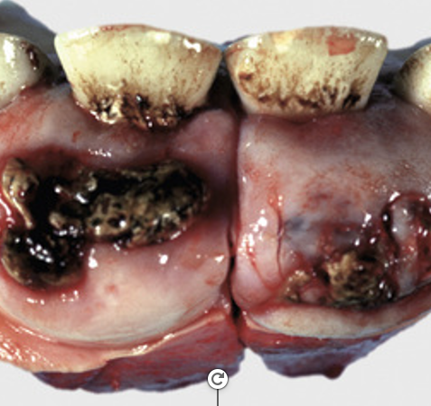 \-disorganized but mature mesenchymal or epithelial tissues found in their normal anatomic location 

\-consist of abnormal proliferations of blood vessels 