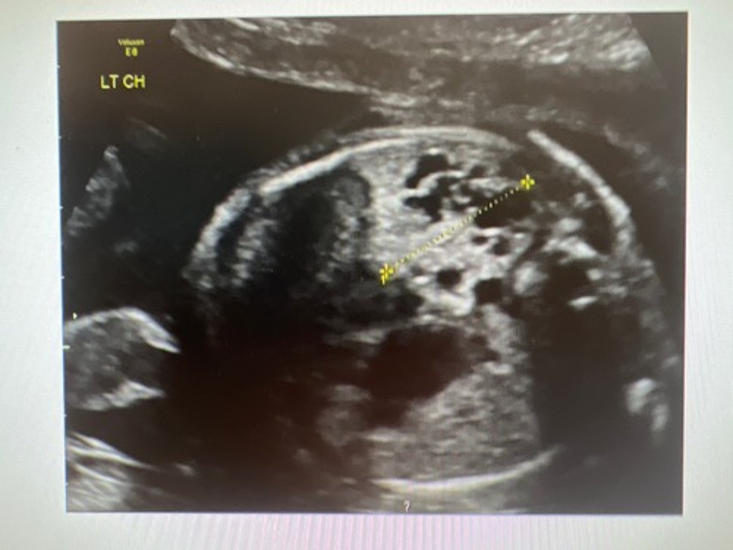 <p>Congenital Pulmonary Airway Malformation</p>
