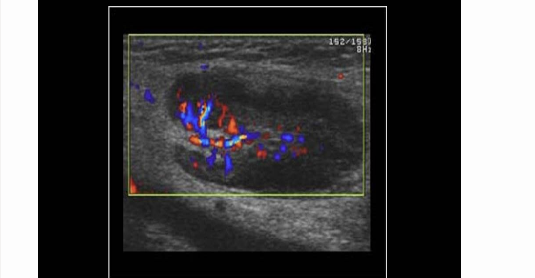<p>pt has groin pain 3 days after undergoing right femoral artery angioplasty. this is right groin AOI. what should you put in your report</p><p>.</p><p>a) pseudoaneurysm that’s nearly thrombosed</p><p>b) abn enlarged LN</p><p>c) pseudoaneurysm requiring immediate attention</p><p>d) normal LN </p>