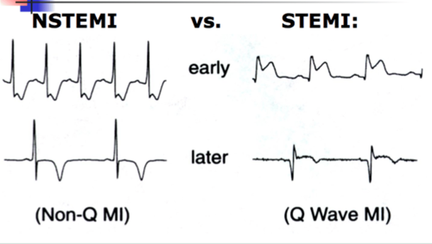 <p>Widespread, concave ST elevation across multiple leads is the hallmark sign of Acute Pericarditis.</p>
