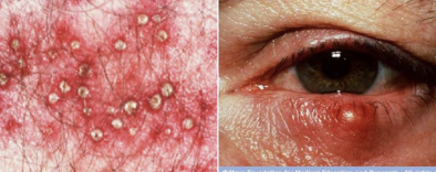 <p><span><span>Staphylococcus aureus infections</span></span></p><p>Folliculitis = infection of hair follicles. A sty is folliculitis of an eyelash.</p>