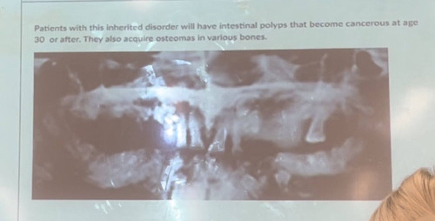 <p>Patients with this inherited disorder will have intestinal polyps that become cancerous at age 30 or after. They also require osteomas in various bones</p>