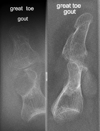 <p>Inherited metabolic disorder → excess uric acid → crystal deposits (tophi) in joints.</p>