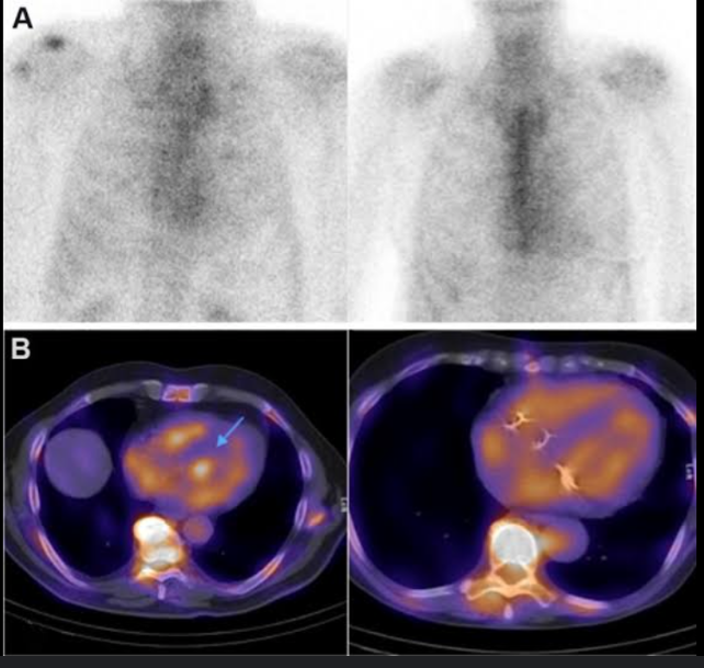 <p>Infarcted myocardial tissue shows an increased uptake of technetium Tc 99m compared with healthy tissue. The isotope is injected parenterally, and serial images of the heart are obtained to evaluate the location and extent of the myocardial damage.</p>