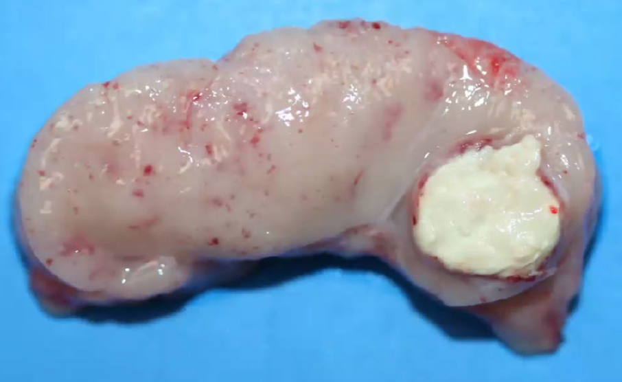 <p>What is a histologic feature?</p><p>A-Large number of acid fast bacilli</p><p>B-Rare acid fast bacilli</p><p>C-Large number of parallel-called hyphae</p><p>D-Moderate number of mites</p>