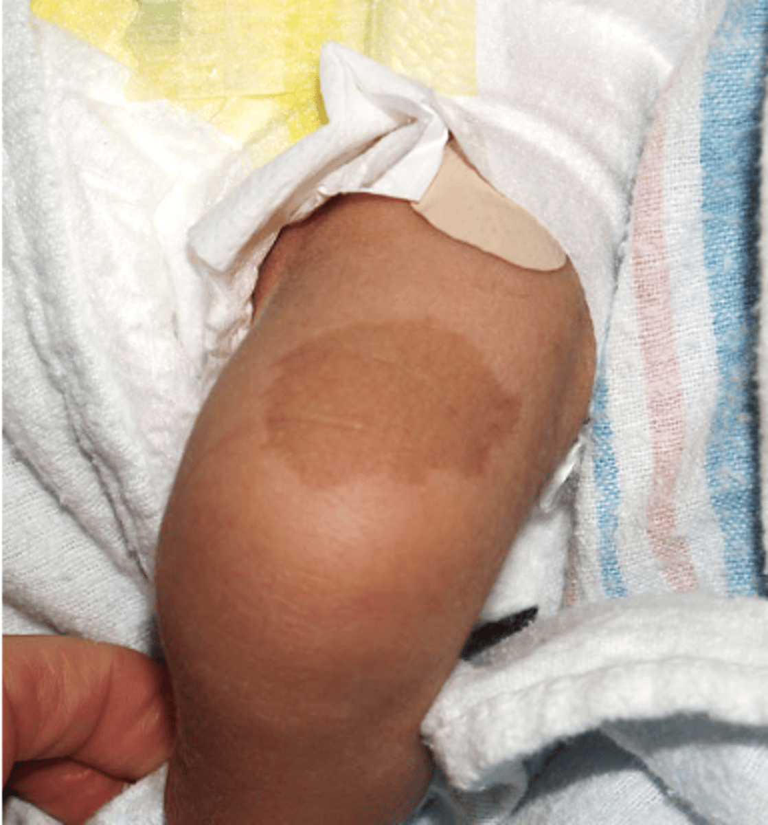 <p>- Hyperpigmented macules, usually benign</p><p>- Presence of 6 or more that are >1.5 cm in adults or >0.5 cm in prepubertal children may be indicative of neurofibromatosis I</p>