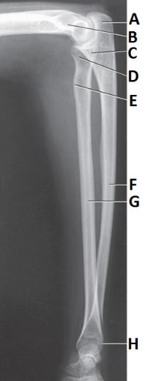 <p>In this Lateral Forearm and Elbow projection, what is indicated by label D?</p>