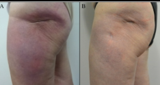 <p>affects subq fat</p>