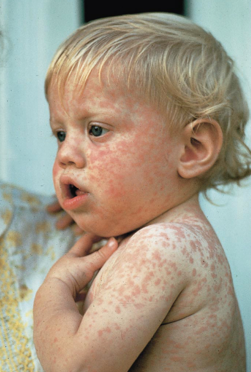 Measles (Rubeola) virus: Viral skin lesions