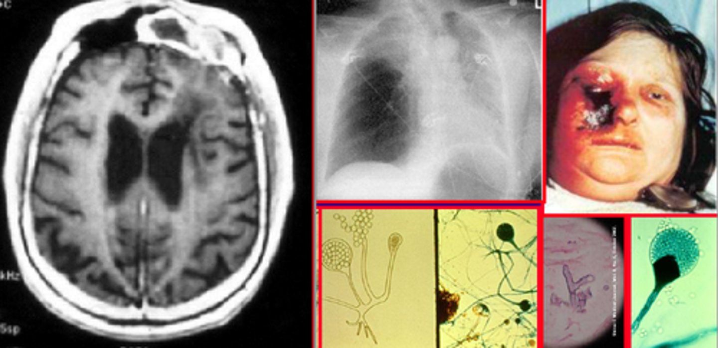 <p>Mucor or Rhizopus fungal infection</p><p>Travels through cribiform plate vessels</p>