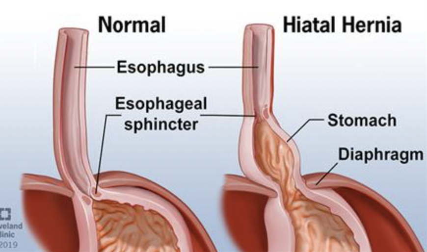 A defect in the opening of the diaphragm that allows part of the stomach to protrude into the thoracic cavity.

They can interfere with the normal functioning of the lower esophageal sphincter which leads to REFLUX