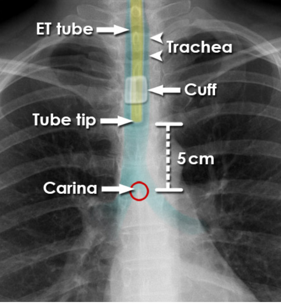 <p>In the trachea, 5–7 cm above the carina in neutral neck position.</p>
