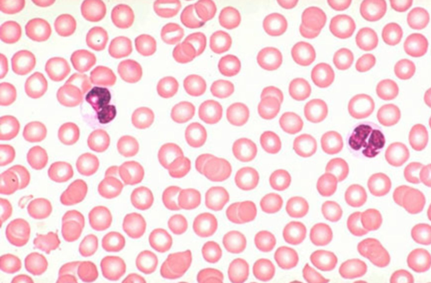 <p>Platelet deficiency<br>Even normal movements can cause bleeding from small blood vessels that require platelets for clotting</p>
