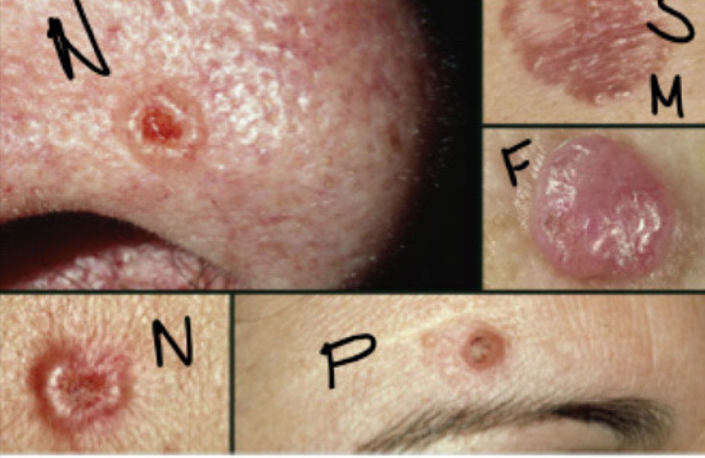 <p>Sclerosis BCC /Morpheaform BCC</p>
