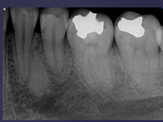 <ol><li><p>well-defined periphery but may blend w/ trabeculae of surrounding bone</p></li><li><p>no effect on teeth but rarely associated w/ root resorption </p></li><li><p>similar opacity as cortical bone </p></li></ol><p></p>