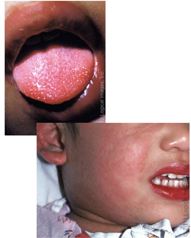 <p><span><strong>widespread inflammation of small to medium sized arteries, leading cause of heart disease in children </strong></span><br><span>-rare, typically &lt;5yo, AMAB&gt;AFAB, ↑risk in Asian descent</span></p><p><span>S/S: </span><br>-<span><strong>significant prolonged high fever</strong></span><br>-<span><strong>bilateral nonexudative conjuctivitis</strong></span><br>-<span>erythema of lips and oral mucosa <strong>(strawberry tongue)</strong></span><br>-<span>extremity changes <strong>(swelling, skin peeling)</strong> </span><br>-<span>cervical lymphadenopathy</span></p><p><span>Dx: clinical diagnosis; CBC, AST/ALT, CRP, ESR, urinalysis, ECHO</span><br><span>Tx: <strong>IVIG +/- glucocorticoids</strong>, <strong>high dose aspirin</strong> (use caution Reyes)</span><br><br><em>Prognosis: </em>based on cardiac involvement: <strong>coronary aneurysm, </strong>myocardial infarction, myocarditis </p>