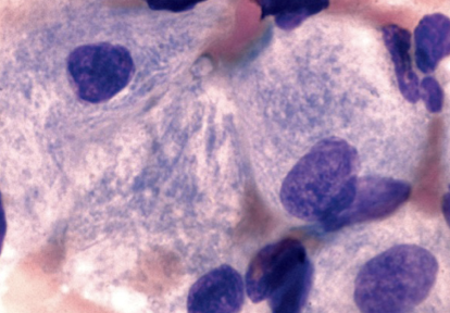 <p>Most common lysosomal lipid storage disease; unmetabolized lipid accumulates in the macrophages throughout the body; BM contains macrophages that have <strong><u>abundant fibrillar blue gray cytoplasm</u></strong> with wrinkled apeparance</p>