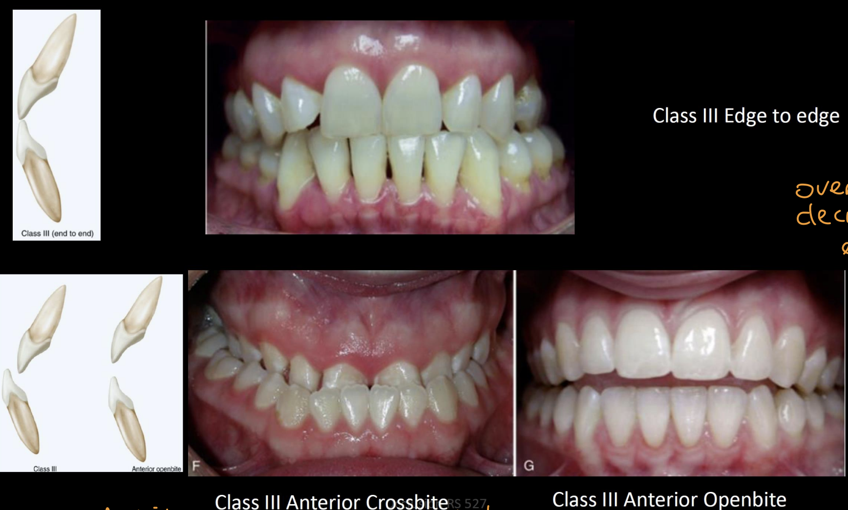 <p>Edge to edge, anterior crossbite, anterior openbite</p>