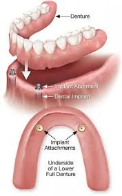 <p><span>a removable dental prosthesis that rests on a few remaining natural teeth or dental implants</span></p>