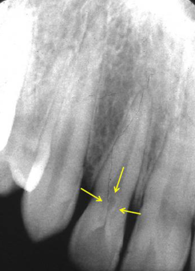 <p></p><p>Dens in dente/invaginatus- invagination of enamel&nbsp;</p><p>Palatal groove on lingual surface</p>