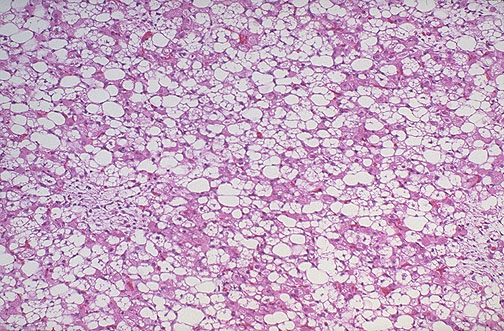 <ol><li><p>Cell of origin in liposarcoma</p></li><li><p>Cellular feature of neoplastic cells</p></li></ol><p></p>