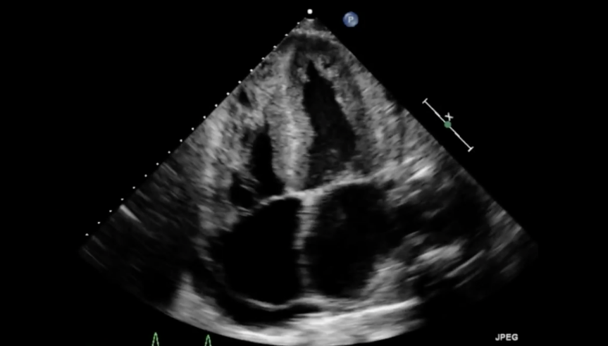 <p>Heterogeneous speckled appearance of the myocardium of the RV and LV consistent with? </p>