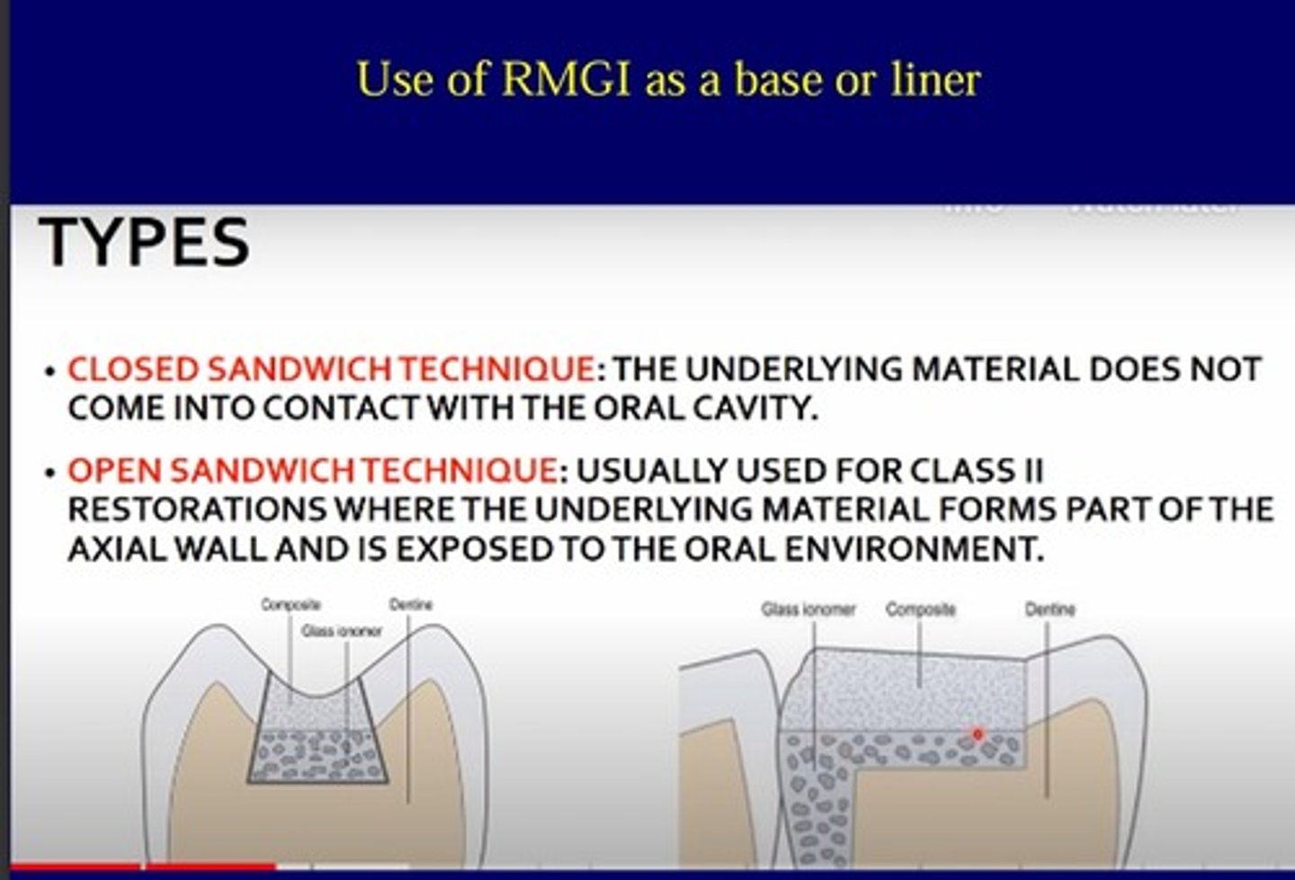 <p>Closed: the underlying material does not come into contact with the oral cavity</p><p>Open: usually used for class 2 restorations where the underlying material forms part of the axial wall and is exposed to the oral environment</p>