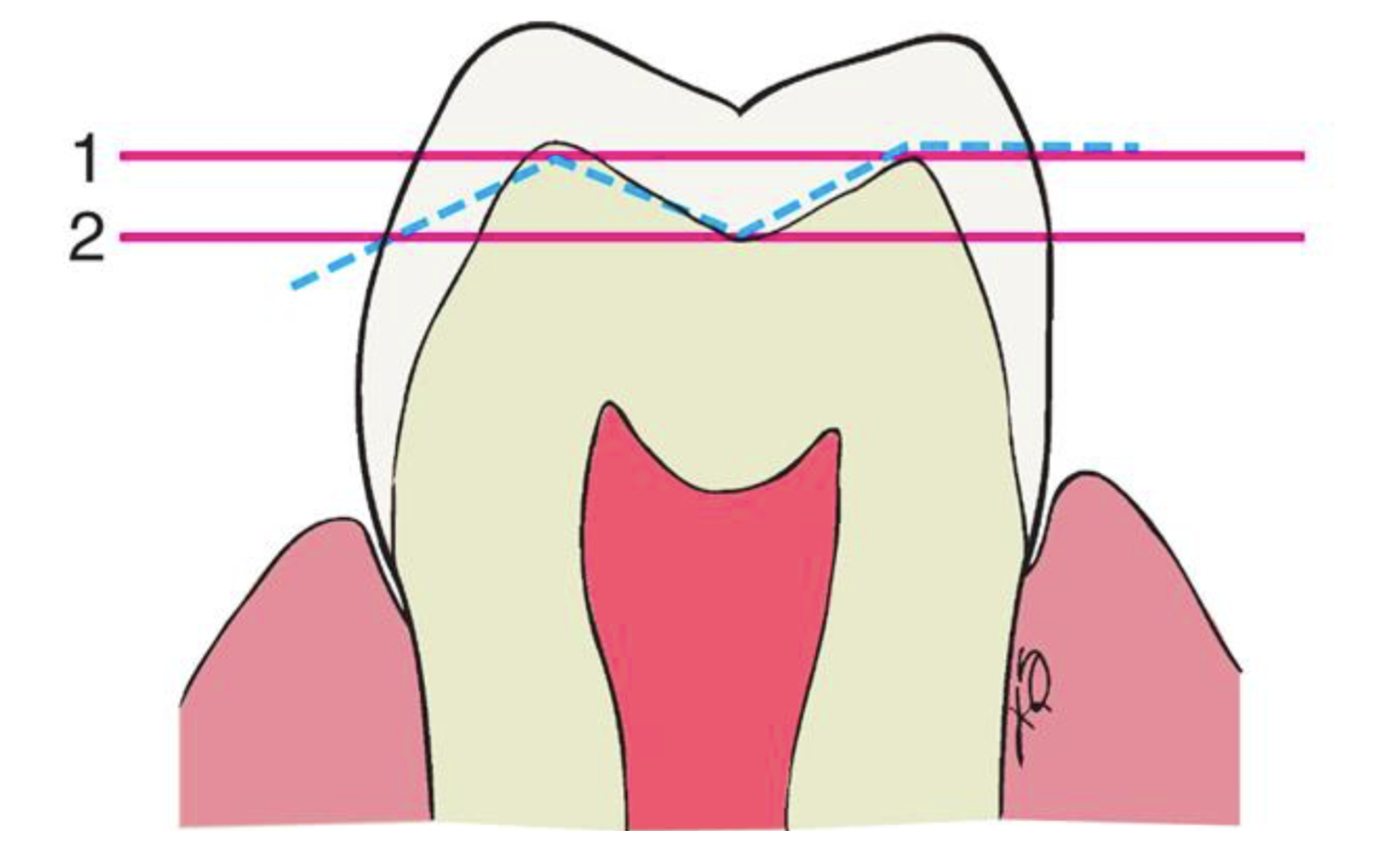 <p>an anatomically prepared occlusal surface </p>