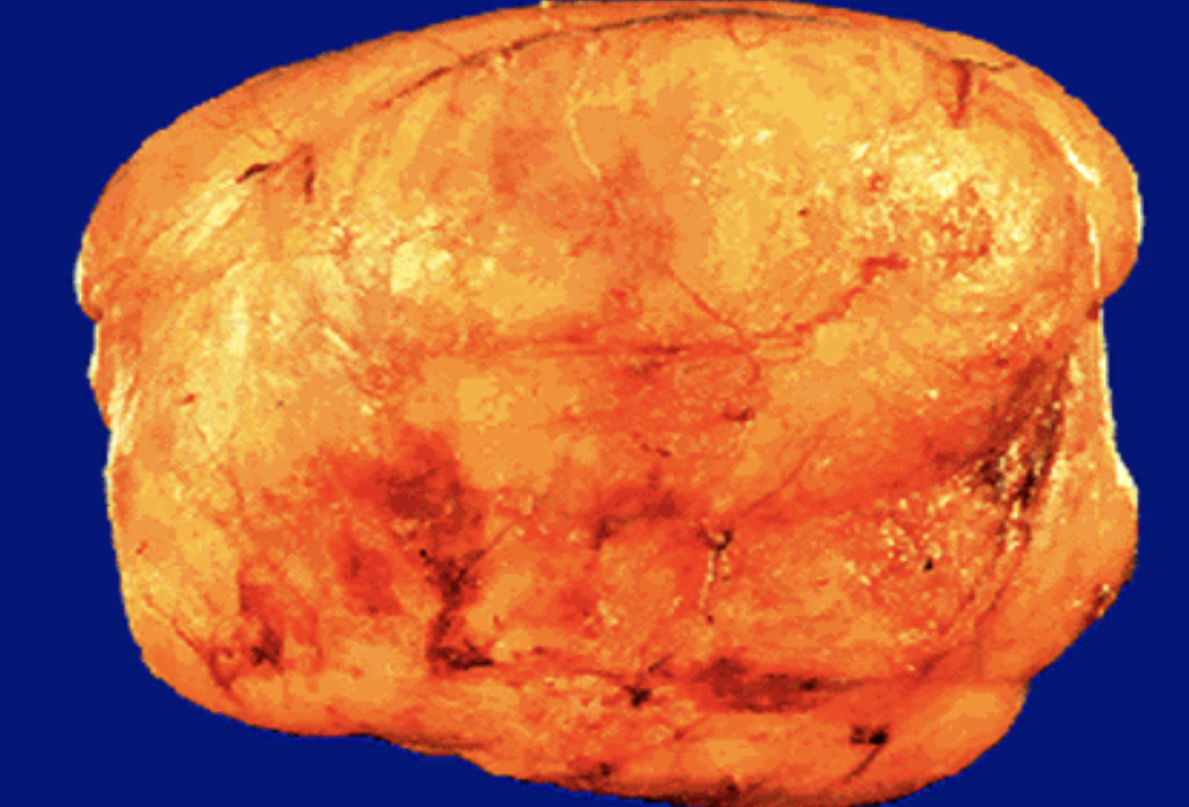 <p>Identify the <strong>organ</strong> and the <strong>diagnosis</strong> in this format: <em>diagnosis, organ</em></p>