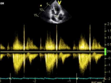 <p>Identify the spectral Doppler waveform:</p>