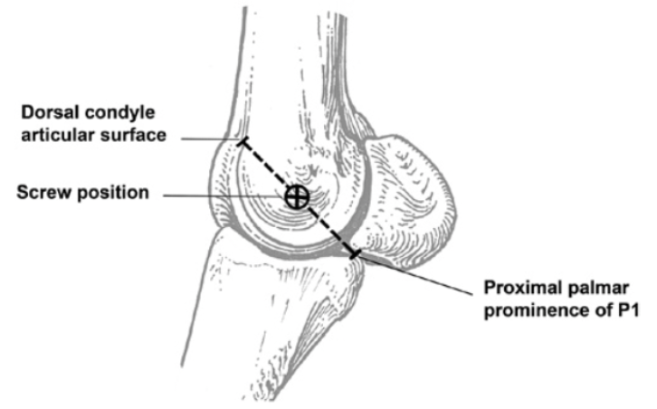 <ul><li><p><span>Repaired with screws applied in lag fashion using minimal soft tissue dissection</span></p></li><li><p><span>Distal screw is usually placed as centrally as possible in the lateral condylar (epicondylar) fossa</span></p><ul><li><p><span>This site can be accurately estimated by taking the midpoint of an imaginary line drawn between the proximal palmar/plantar prominence of the proximal phalanx and the most dorsal aspect of the lateral condyle</span></p></li></ul></li><li><p><span>A more distally and/or palmarly/plantarly placed screw may be used for short, incomplete, or unicortical fractures to achieve maximal compression across an incomplete fracture plane</span></p></li><li><p><span>Stab incision is made down to the surface of the bone in this location and parallel with the collateral ligament fibers to minimize injury to them</span></p></li><li><p><span>Can feel scalpel slide into the fossa, confirming accurate placement of the incision</span></p></li><li><p><span>As many additional screws as needed are placed at 15-20 mm intervals more proximad</span></p></li><li><p><span>Placing a screw too close to the proximal end of the fracture increases the risk of splitting the tapering end of the fragment or entering a fracture line and does not significantly contribute to the outcome of the case</span></p></li><li><p><span>Either 4.5 or 5.5 mm cortex screws can be used</span></p><ul><li><p><span>Screw failure is rarely a problem in nondisplaced non comminuted fractures</span></p></li><li><p><span>4.5 mm screws have the advantage of being replaceable with a larger cortex screw if the bone thread are stripped</span></p></li></ul></li></ul>