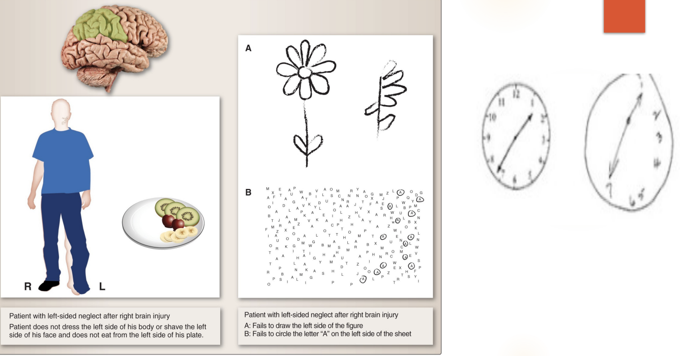 <p>Left side neglect, more common after the right side is damaged</p>