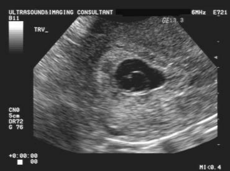 <p>what sonographic sign does this represent and what does that sign actually show?</p>