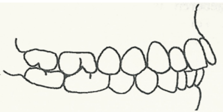 <p>Dit is de normale relatie. De eerste ondermolaar staat hierbij een halve premolaarbreedte naar mesiaal ten opzichte van de 1<span style="line-height: normal;"><span>ste</span></span> bovenmolaar. Transversaal (in dwarsdoorsnede gezien) staan boven en onder de middellijnen mooi tegenover elkaar.</p>