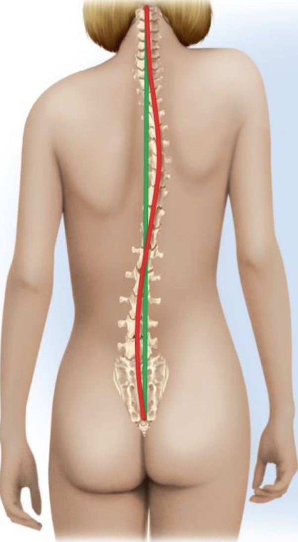 <p>what abnormal curvature is depicted</p>
