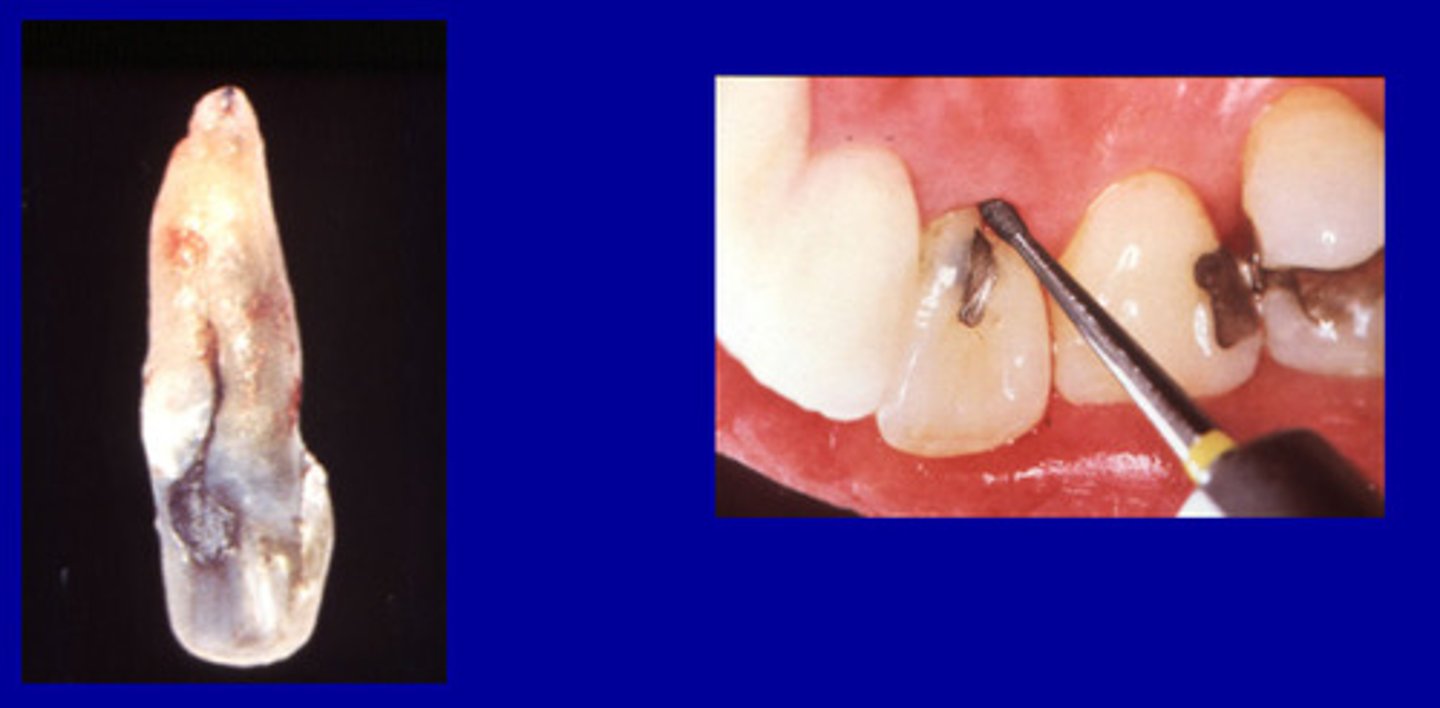 <p>Fine depressed lines in the enamel of a tooth that mark the union of the loves of the crown.</p>