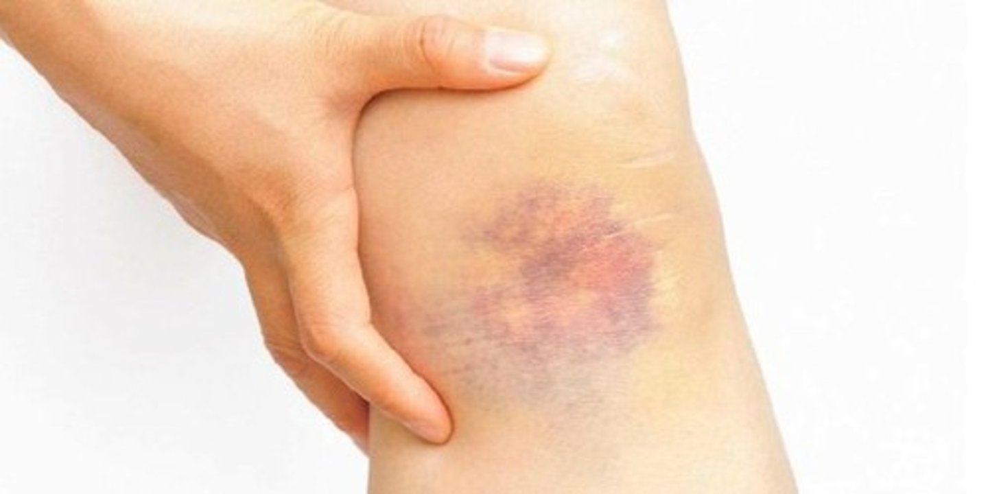 <p>bruise</p>