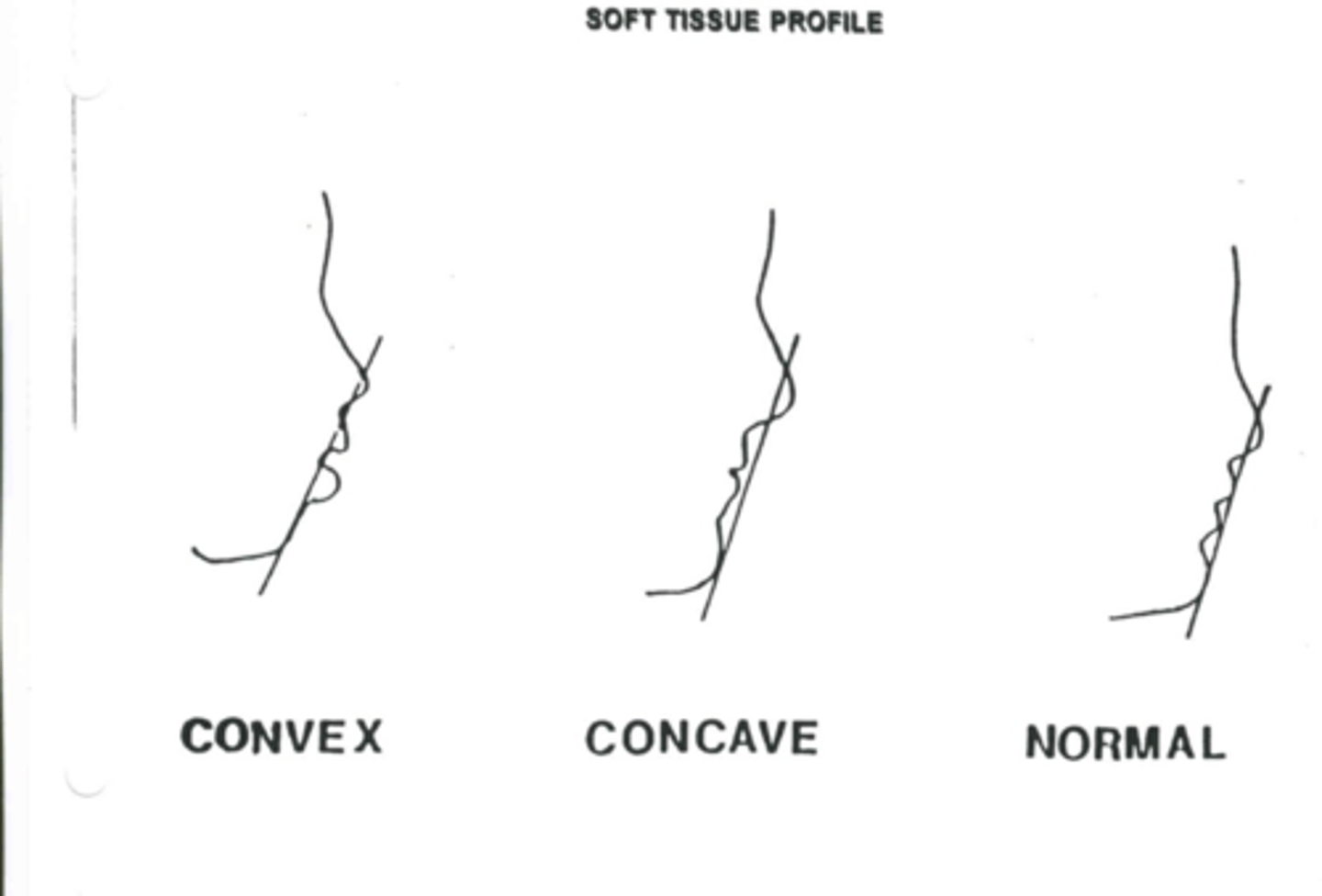<p>upper &amp; lower lips are ahead of a line connecting a point halfway along the lower border of the nose and the most forward point on the chin</p>