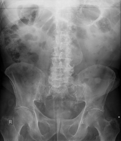 <p>Abdominal Aortic Aneurysm (AAA)</p>