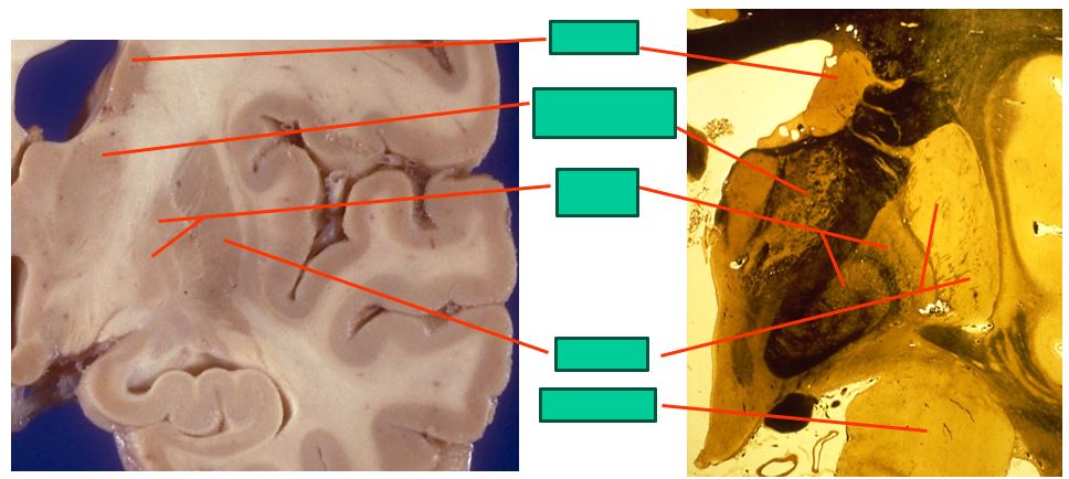 <p>the mid-level basal ganglia looks like this</p>