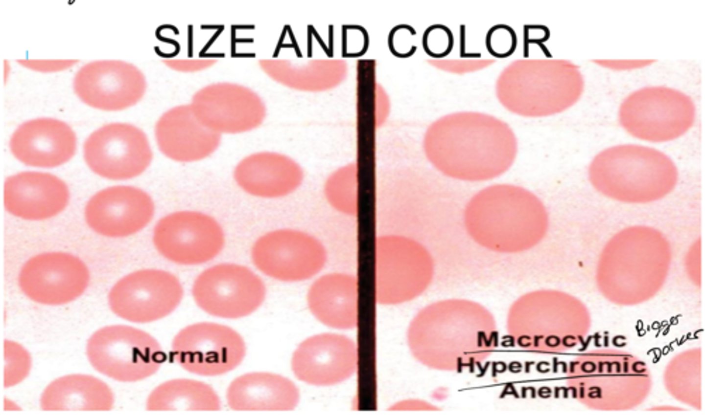 <p>What are some reasons as to why Mean Corpuscular Volume (MCV) values might be high &gt; 96 (macrocytic)?</p>