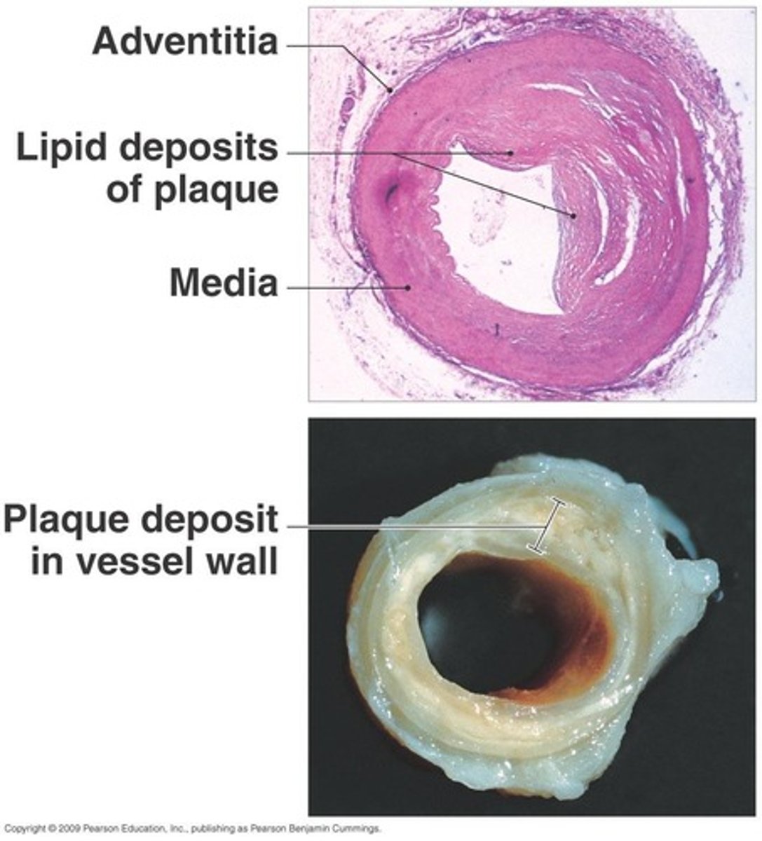 <p>A condition characterized by the hardening and narrowing of the arteries due to plaque buildup.</p>