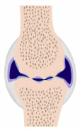 <p>type of arthritis that happens when the <strong>cartilage that lines ur joins is worn down and ur bones rub against each other</strong></p>