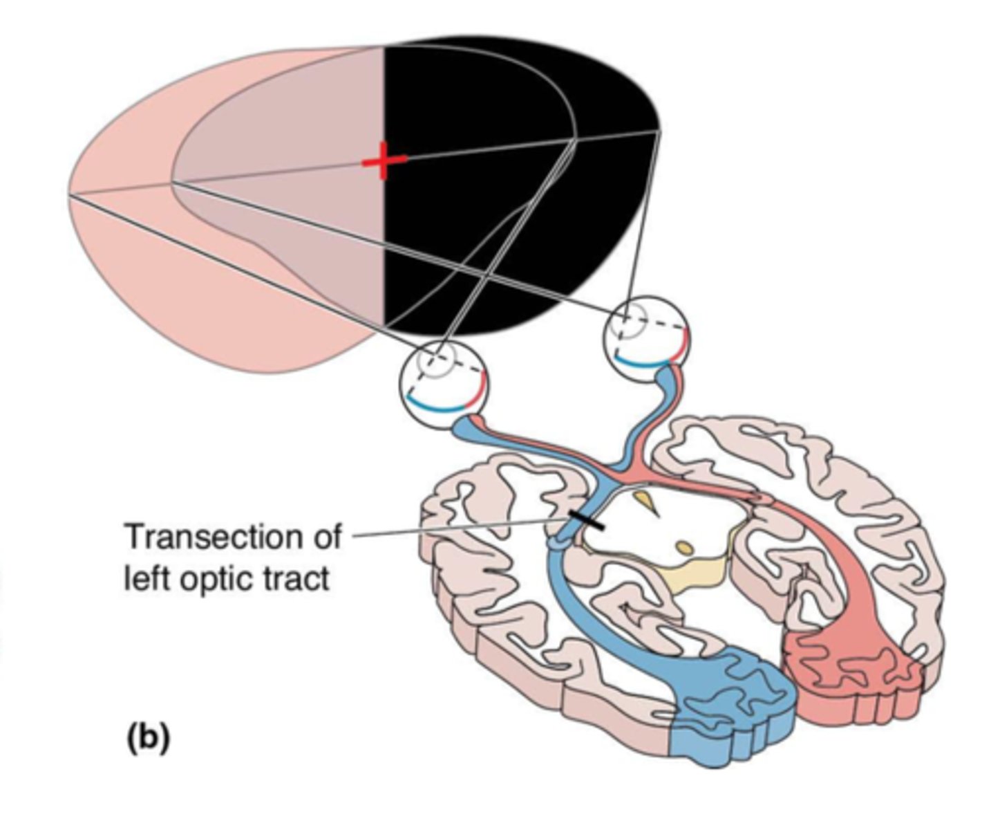 <p>Contralateral (L) homonymous hemianopia (loss of opposing visual fields on both eyes)</p><p>NOTE: this picture depicts a lesion @ L optic tract</p>