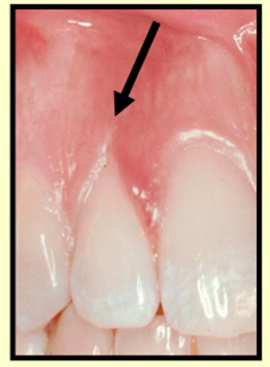 <p>v shaped loss of gingiva. Due to bad flossing habits</p>