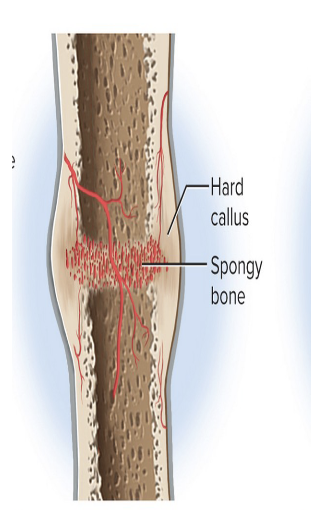 <ul><li><p><strong>Osteoblasts </strong>build a <strong>hard bony collar </strong>(hard callus) around the fracture</p></li><li><p>Acts as a <strong>temporary splint</strong></p></li><li><p><strong>Must keep the bone immobilized </strong>so it doesn’t break again</p></li></ul><p></p>