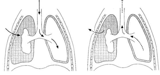 <ul><li><p>durch Luft zwischen Rippen- und Lungenfell, löst sich deren Verbindung => Lungenflügel können der Bewegung des Brustkorbs nicht mehr folgen</p></li></ul>