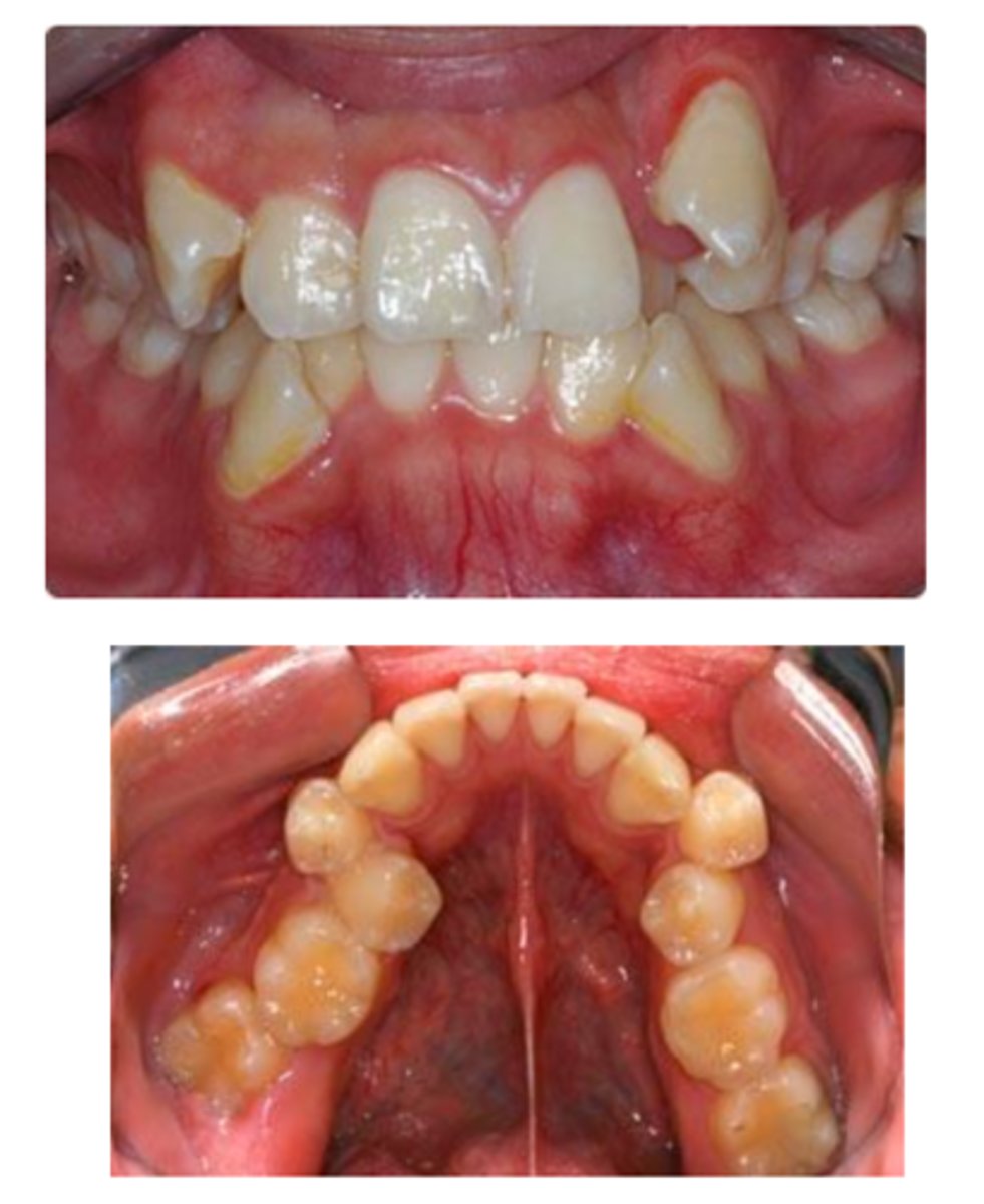 <p>Improper contacts and interproximal spaces may result in:</p>