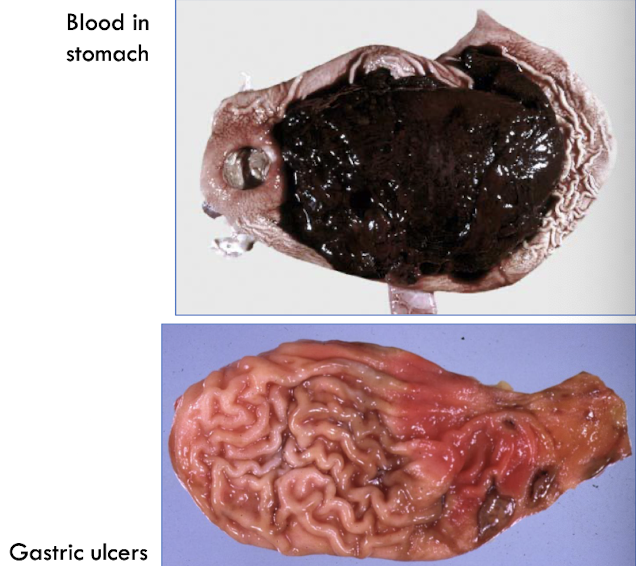 <p>local disturbances in mucosal epithelial barrier, gastric acidity (hypersecretion), blood flow</p>