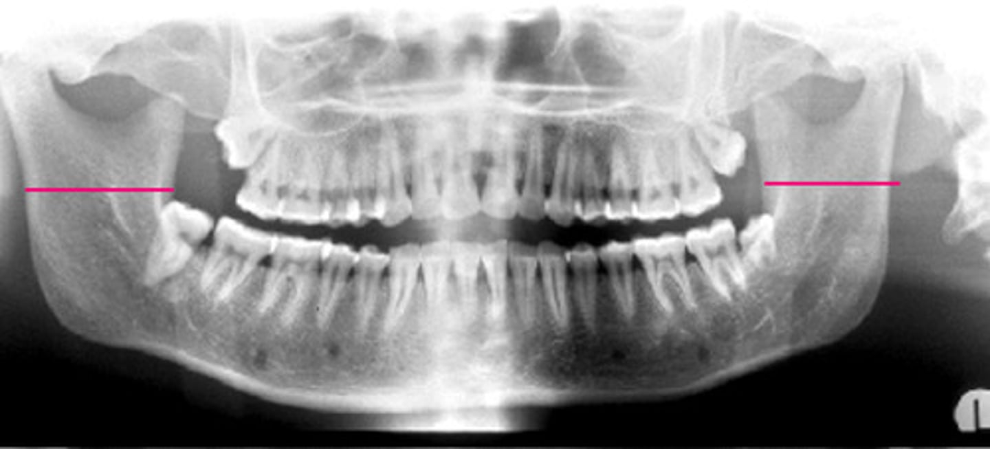 <p>What error is present on panoramic? *Hint pay attention to the width of the ramus</p>